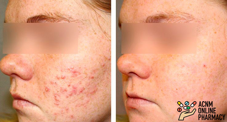 accutane before and after